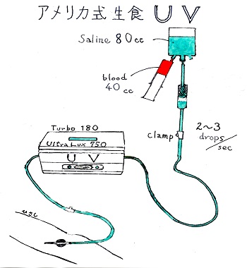 アメリカ式（点滴）